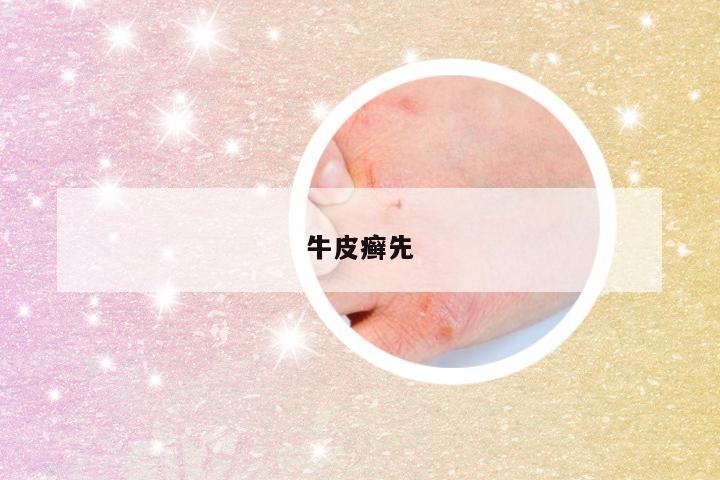 牛皮癣先