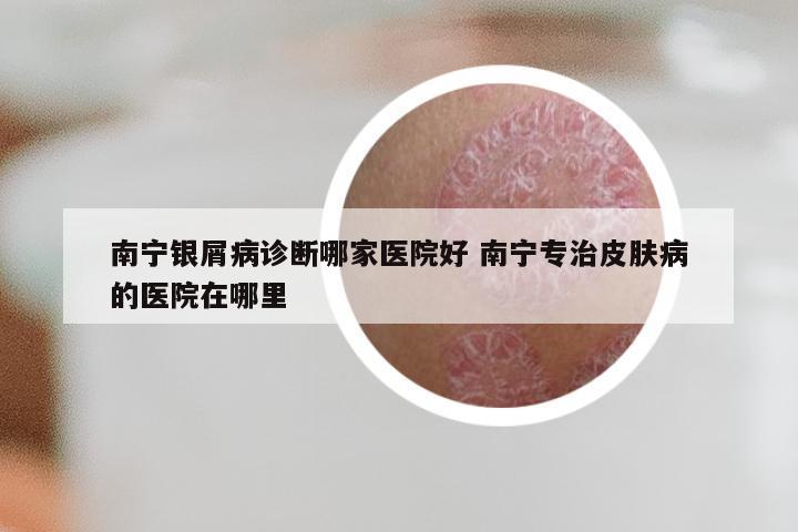 南宁银屑病诊断哪家医院好 南宁专治皮肤病的医院在哪里