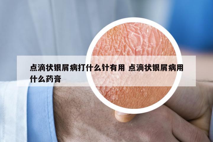 点滴状银屑病打什么针有用 点滴状银屑病用什么药膏