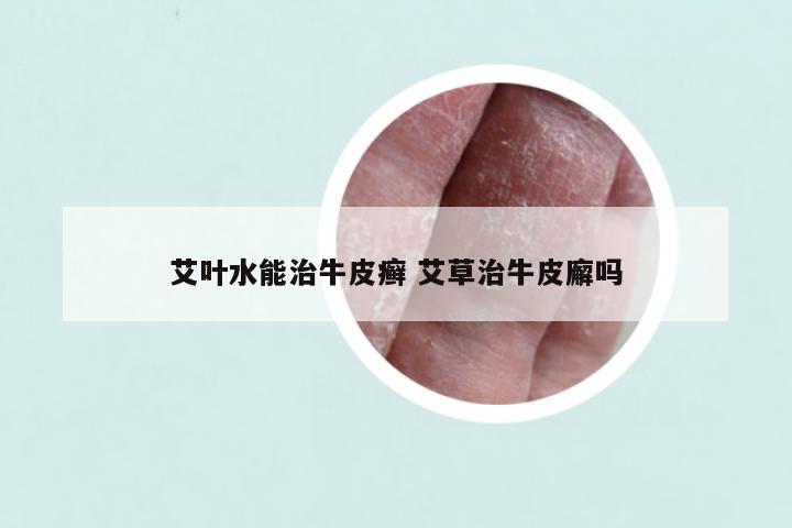 艾叶水能治牛皮癣 艾草治牛皮廨吗