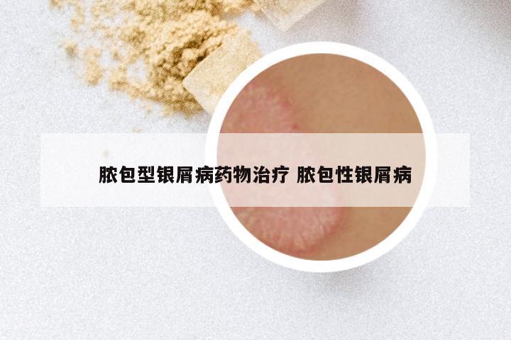 脓包型银屑病药物治疗 脓包性银屑病