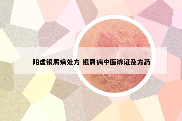 阳虚银屑病处方 银屑病中医辨证及方药