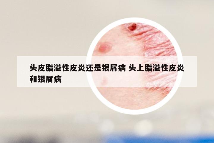 头皮脂溢性皮炎还是银屑病 头上脂溢性皮炎和银屑病