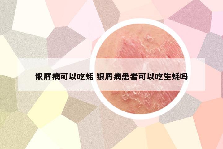 银屑病可以吃蚝 银屑病患者可以吃生蚝吗