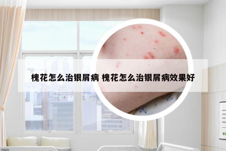 槐花怎么治银屑病 槐花怎么治银屑病效果好