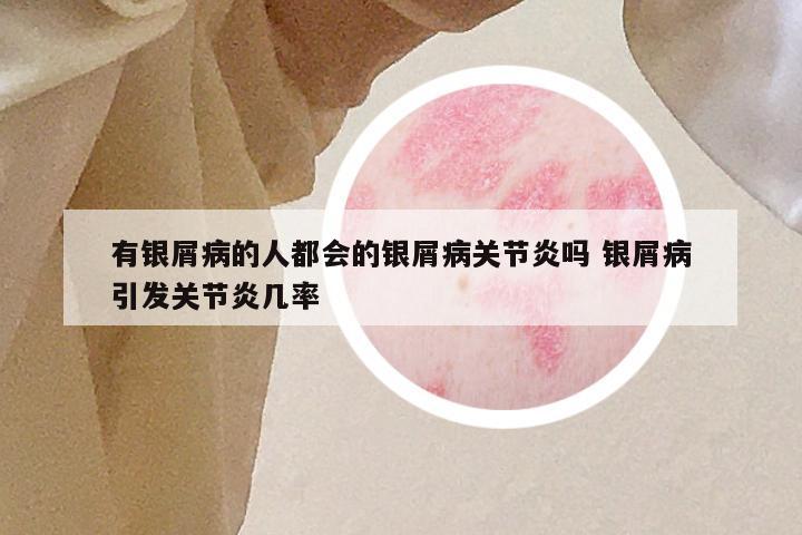 有银屑病的人都会的银屑病关节炎吗 银屑病引发关节炎几率