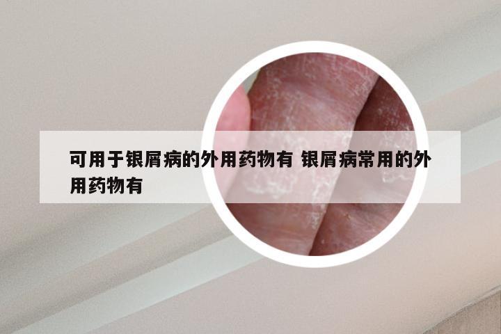 可用于银屑病的外用药物有 银屑病常用的外用药物有