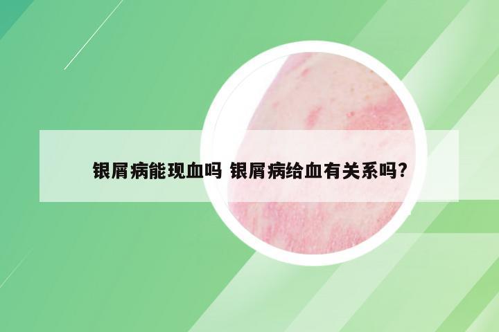 银屑病能现血吗 银屑病给血有关系吗?