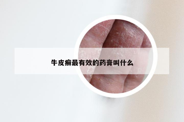 牛皮癣最有效的药膏叫什么