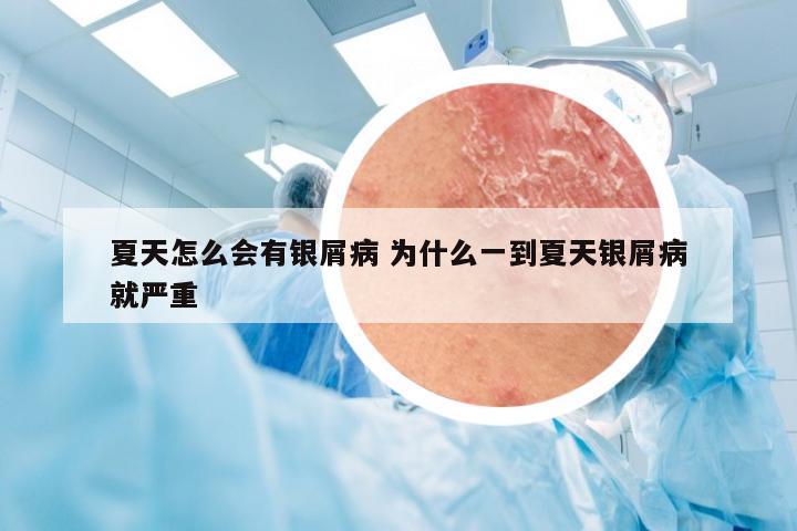 夏天怎么会有银屑病 为什么一到夏天银屑病就严重