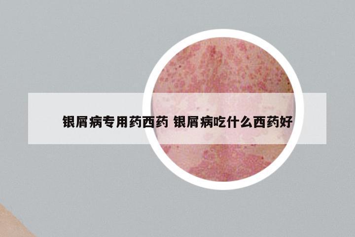 银屑病专用药西药 银屑病吃什么西药好