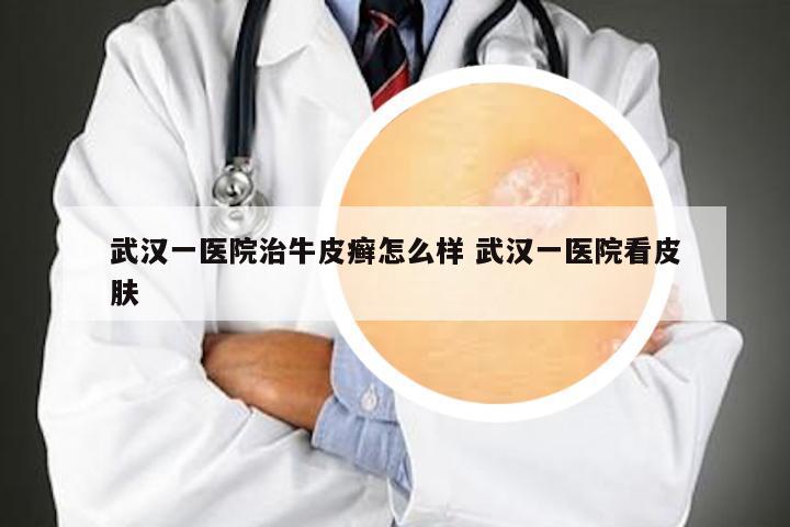武汉一医院治牛皮癣怎么样 武汉一医院看皮肤