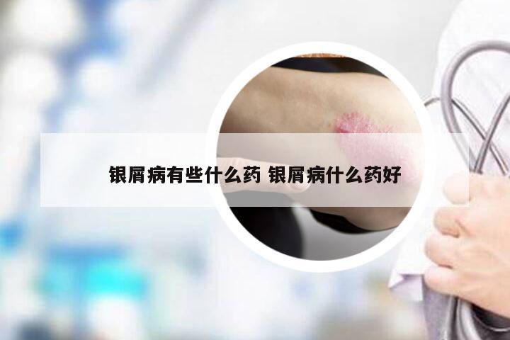 银屑病有些什么药 银屑病什么药好