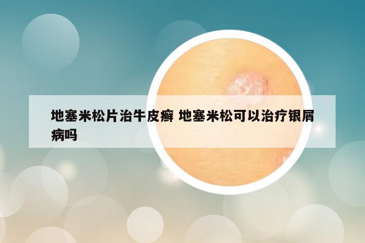 地塞米松片治牛皮癣 地塞米松可以治疗银屑病吗
