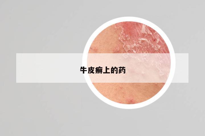 牛皮癣上的药