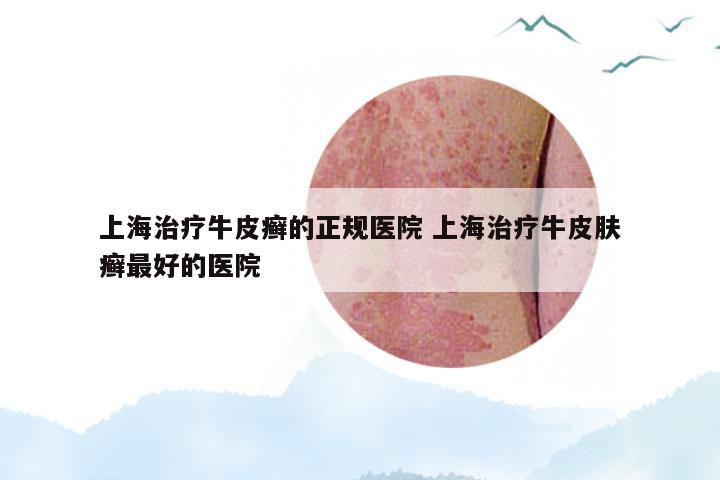 上海治疗牛皮癣的正规医院 上海治疗牛皮肤癣最好的医院
