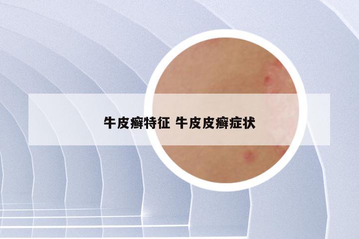 牛皮癣特征 牛皮皮癣症状