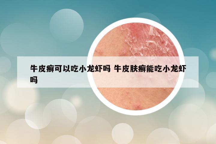牛皮癣可以吃小龙虾吗 牛皮肤癣能吃小龙虾吗