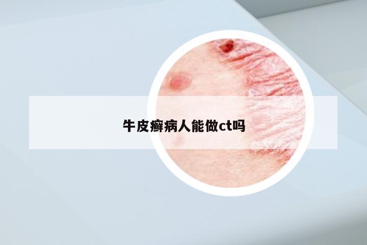 牛皮癣病人能做ct吗