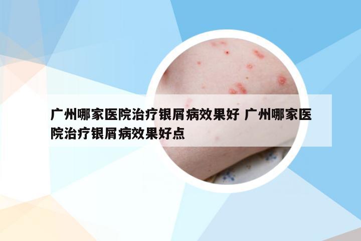 广州哪家医院治疗银屑病效果好 广州哪家医院治疗银屑病效果好点