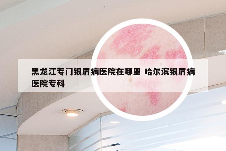 黑龙江专门银屑病医院在哪里 哈尔滨银屑病医院专科