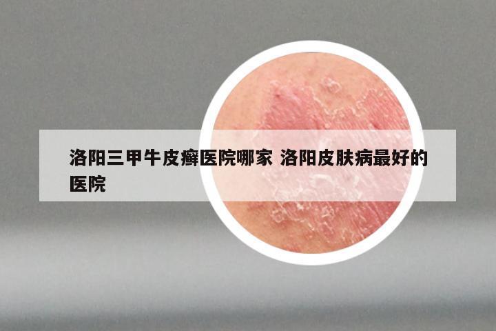 洛阳三甲牛皮癣医院哪家 洛阳皮肤病最好的医院