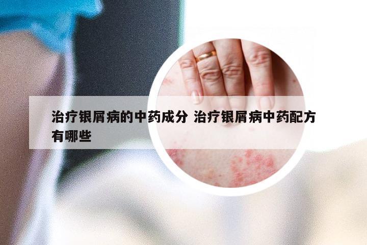 治疗银屑病的中药成分 治疗银屑病中药配方有哪些