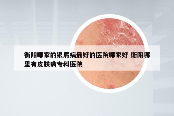 衡阳哪家的银屑病最好的医院哪家好 衡阳哪里有皮肤病专科医院