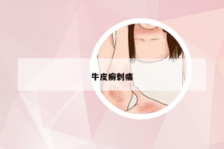 牛皮癣刺痛