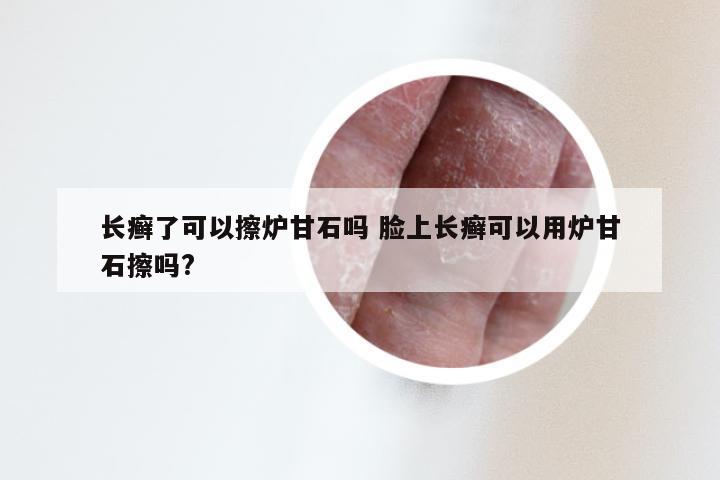 长癣了可以擦炉甘石吗 脸上长癣可以用炉甘石擦吗?