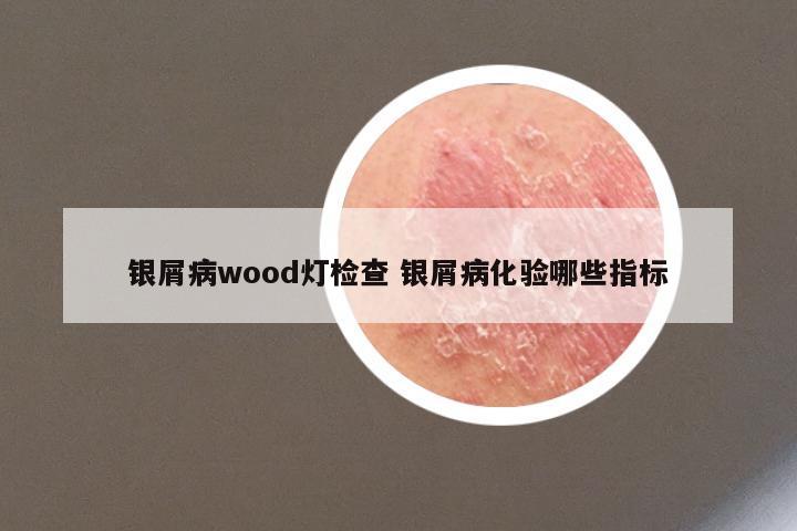 银屑病wood灯检查 银屑病化验哪些指标