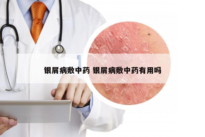 银屑病敷中药 银屑病敷中药有用吗