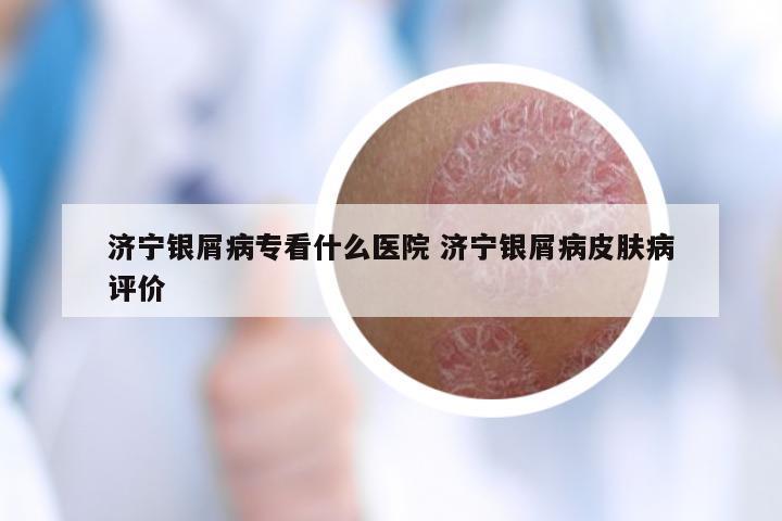 济宁银屑病专看什么医院 济宁银屑病皮肤病评价