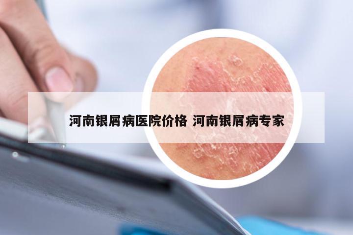 河南银屑病医院价格 河南银屑病专家