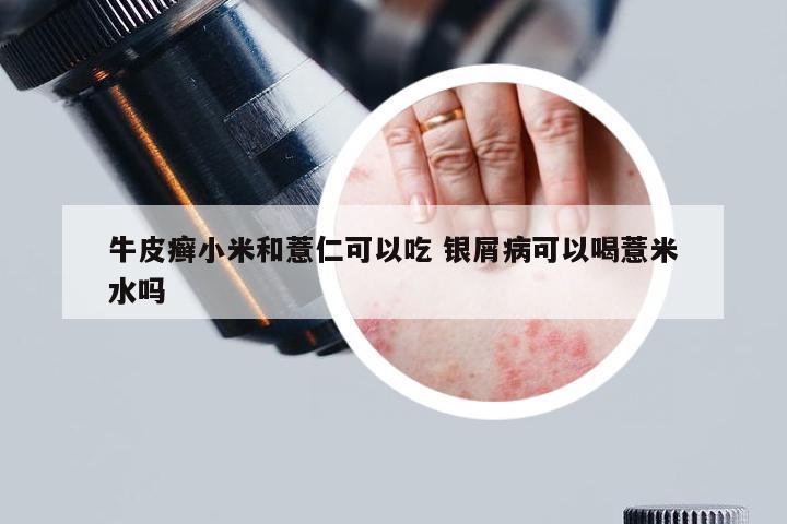 牛皮癣小米和薏仁可以吃 银屑病可以喝薏米水吗
