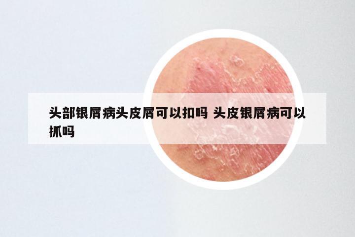 头部银屑病头皮屑可以扣吗 头皮银屑病可以抓吗