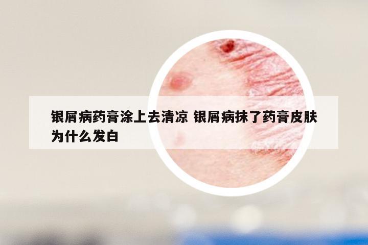银屑病药膏涂上去清凉 银屑病抹了药膏皮肤为什么发白