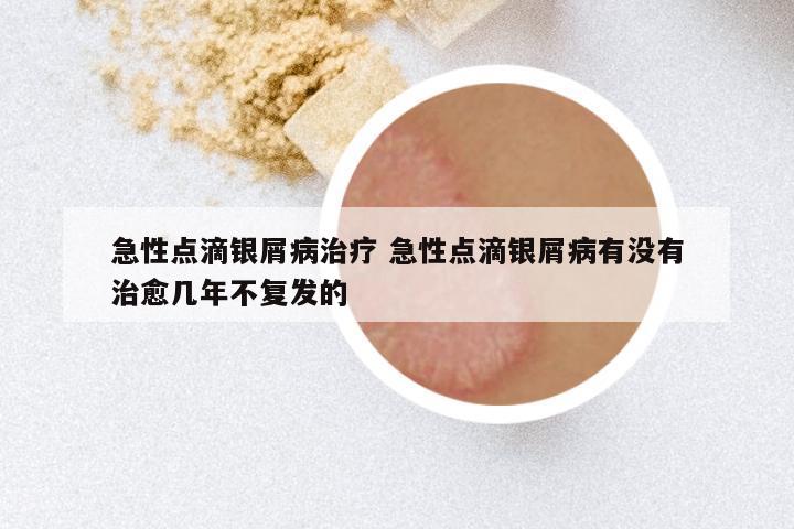 急性点滴银屑病治疗 急性点滴银屑病有没有治愈几年不复发的