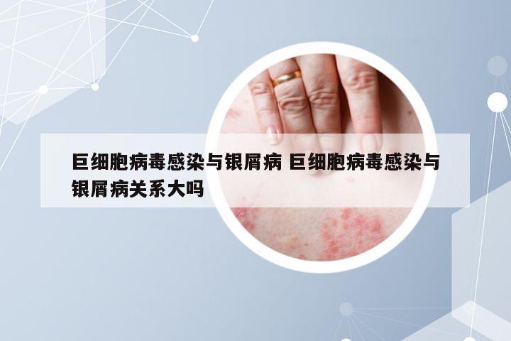 巨细胞病毒感染与银屑病 巨细胞病毒感染与银屑病关系大吗