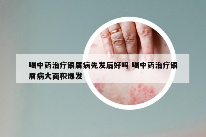 喝中药治疗银屑病先发后好吗 喝中药治疗银屑病大面积爆发