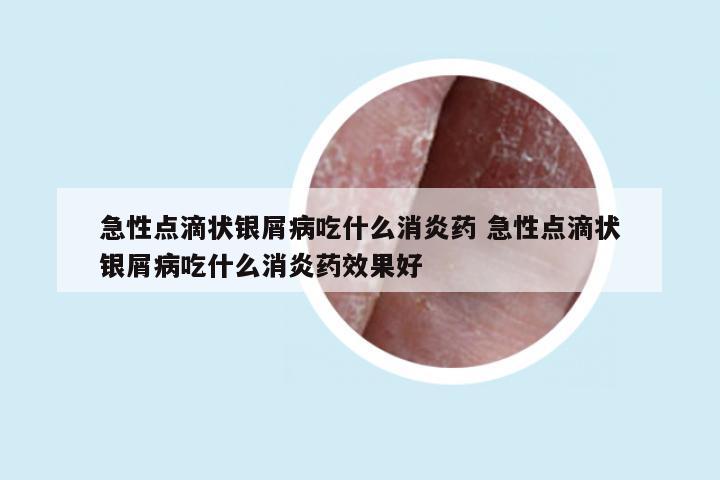急性点滴状银屑病吃什么消炎药 急性点滴状银屑病吃什么消炎药效果好
