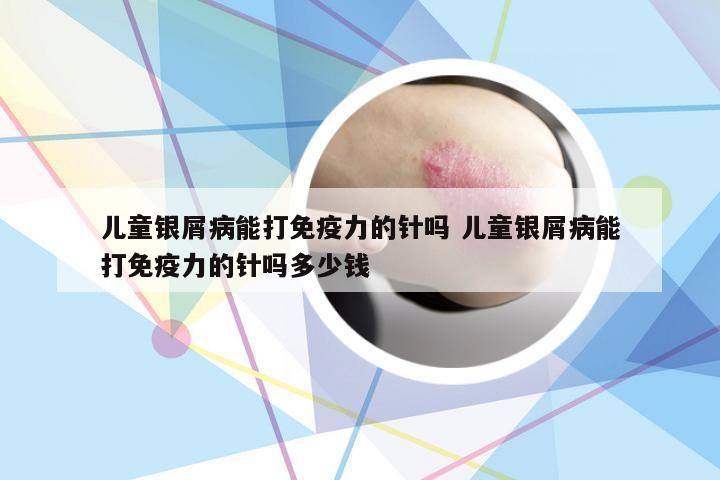 儿童银屑病能打免疫力的针吗 儿童银屑病能打免疫力的针吗多少钱