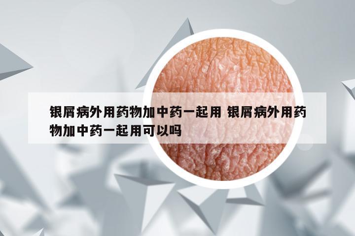 银屑病外用药物加中药一起用 银屑病外用药物加中药一起用可以吗