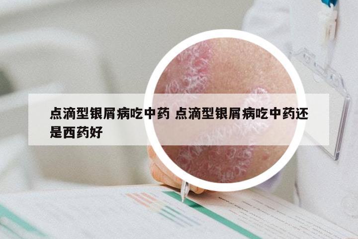 点滴型银屑病吃中药 点滴型银屑病吃中药还是西药好
