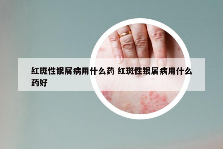 红斑性银屑病用什么药 红斑性银屑病用什么药好