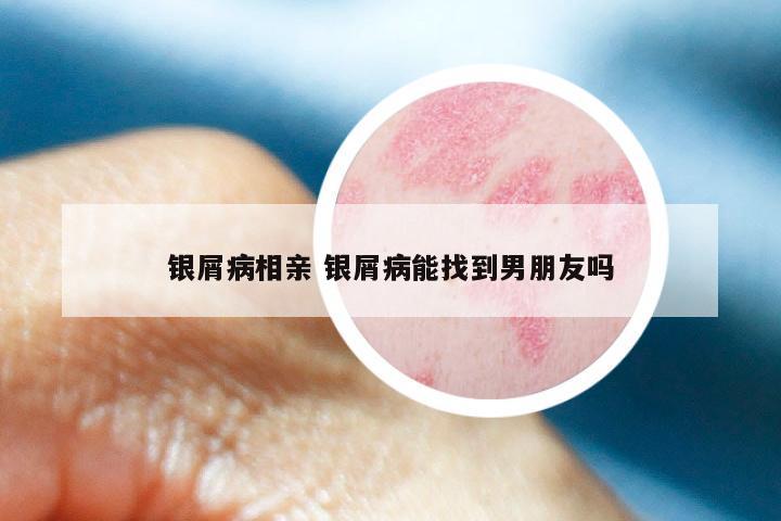 银屑病相亲 银屑病能找到男朋友吗