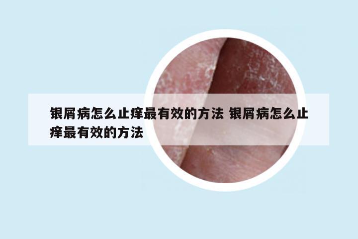 银屑病怎么止痒最有效的方法 银屑病怎么止痒最有效的方法