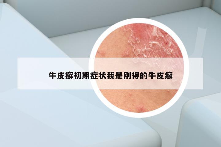 牛皮癣初期症状我是刚得的牛皮癣