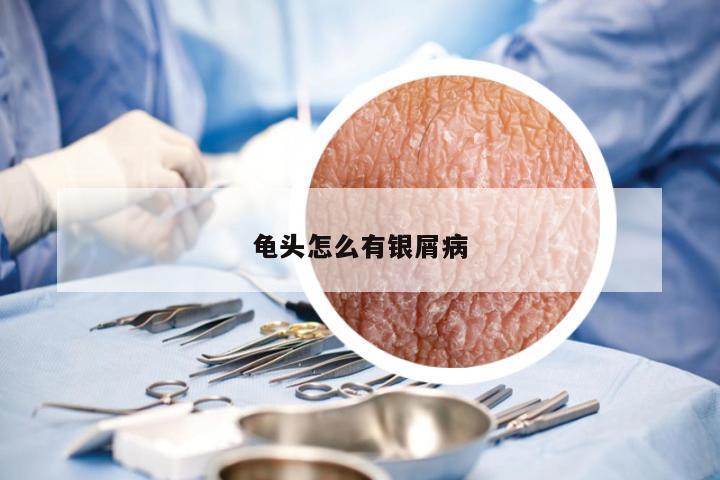 龟头怎么有银屑病