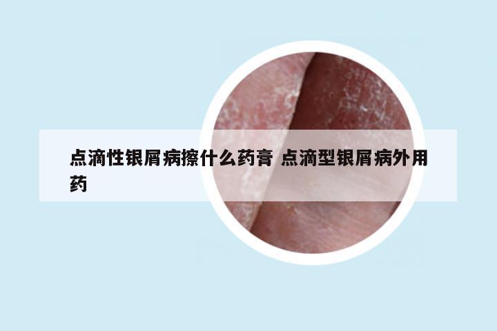 点滴性银屑病擦什么药膏 点滴型银屑病外用药